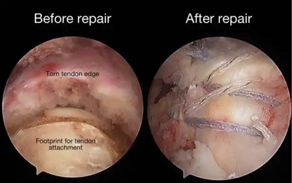 rotator cuff repair surgery singapore