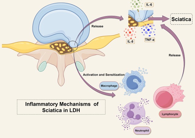 sciatica-lumbar-disc-herniation-inflammatory-markers - Square One Active Recovery inflammatory markers, sciatica pain singapore, tnf-a