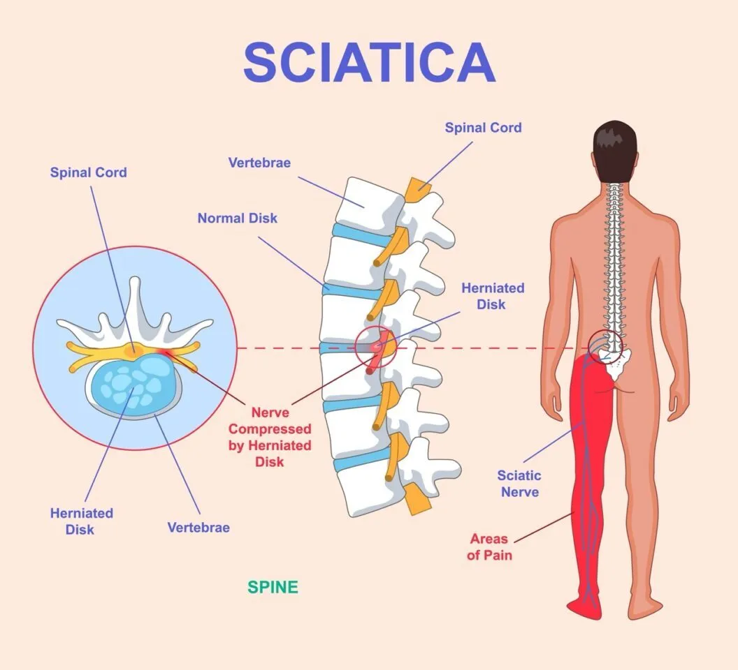 sciatica-treatment-singapore - Square One Active Recovery sciatica treatment singapore, leg pain