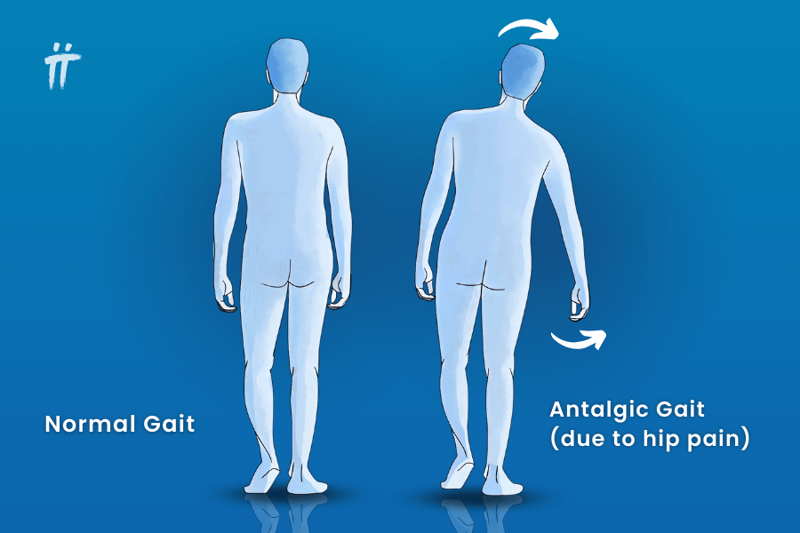 antalgic-gait-hip-pain - Square One Active Recovery antalgic gait, hip pain