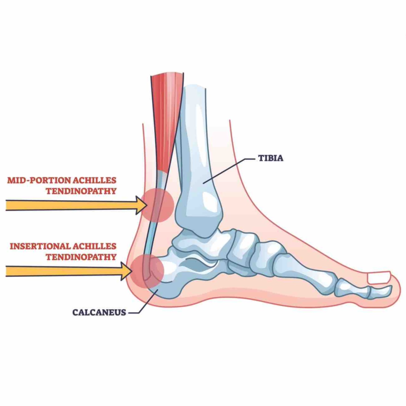 Clinical guide to Achilles tendinopathy loading protocols and tendon remodeling for runners.