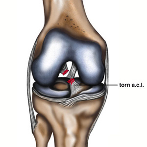 ACL and ligament injury rehabilitation for knee stability