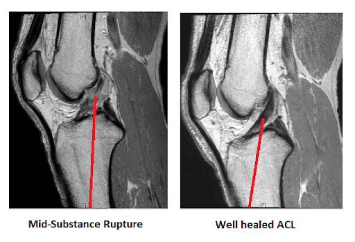 Clinical MRI evidence showing spontaneous ACL healing and recovery without surgery