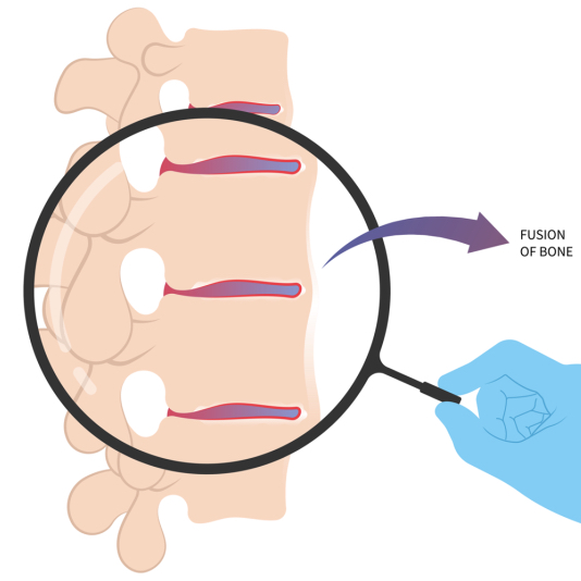 Illustration of Ankylosing Spondylitis showing spinal bone fusion progression
