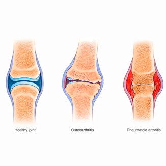 A comparative illustration showing the mechanical wear of osteoarthritis versus the autoimmune inflammation and joint erosion of rheumatoid arthritis.