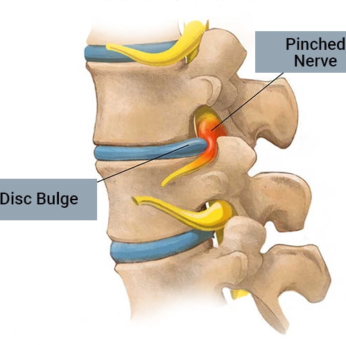 Medical illustration of a cervical disc herniation compressing a nerve root and causing radiculopathy