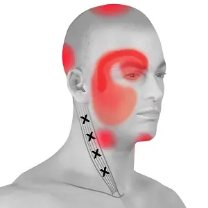 Anatomical map showing pain referral patterns from the C1-C3 vertebrae causing cervicogenic headaches