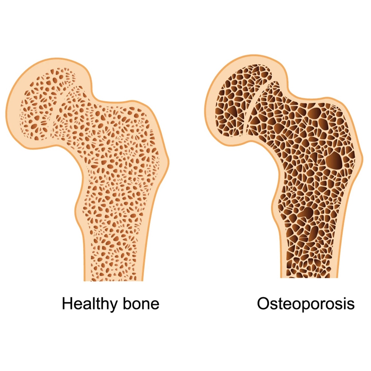 A medical diagram comparing a cross-section of healthy bone tissue with the porous, weakened structure of osteoporotic bone.