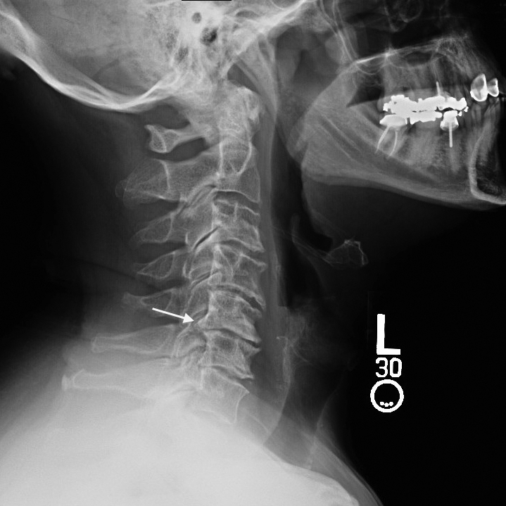 Clinical diagram comparing a healthy cervical spine to one with degenerative disc disease and bone spurs