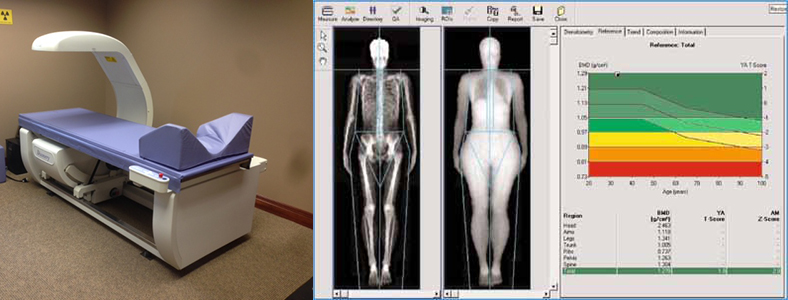 dexa-scan-osteoporosis-muscle-mass - Square One Active Recovery dexa, osteoporosis, muscle mass, bone minal density