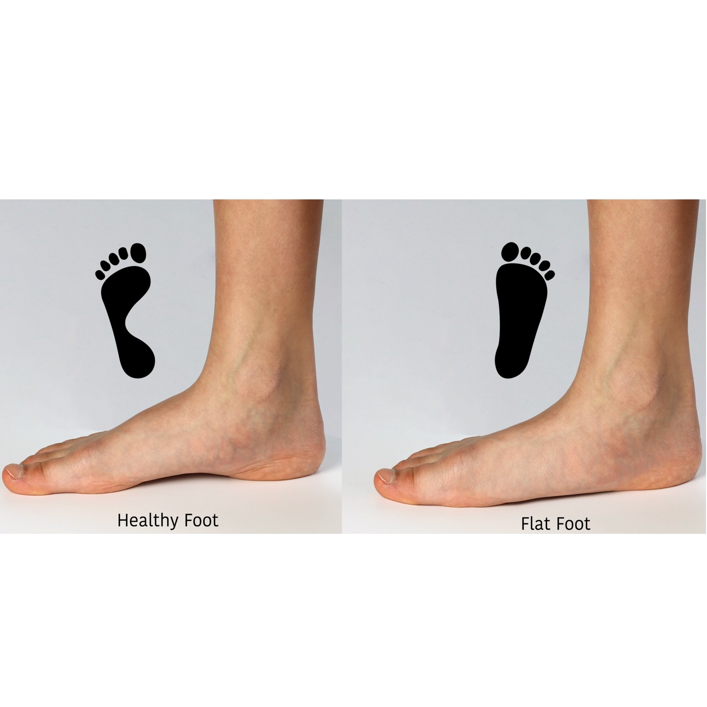 Assessment of flat foot mechanics and functional strengthening exercises at Square One Active Recovery.