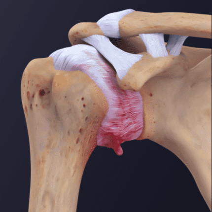 Medical diagram showing adhesive capsulitis (frozen shoulder) with a thickened and inflamed joint capsule.