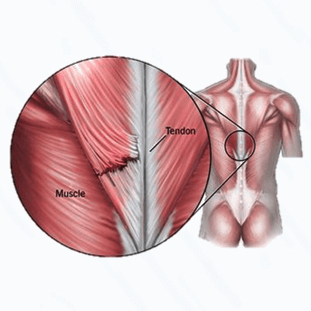 Anatomical illustration of lower back muscle strain and tissue healing