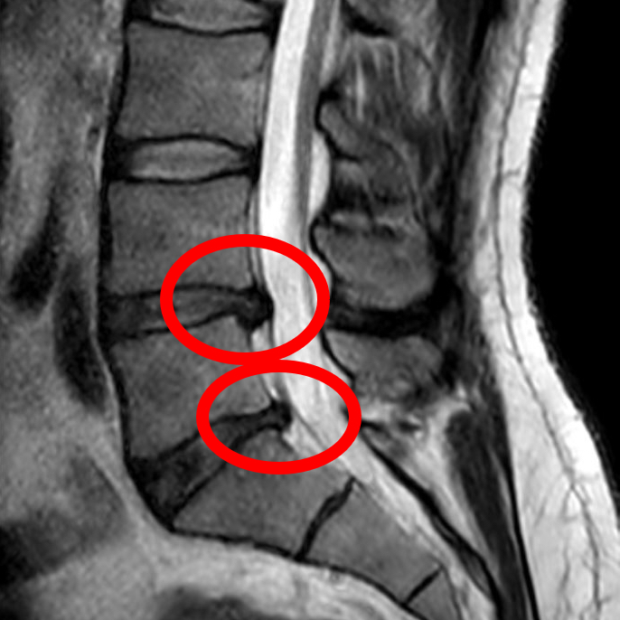 Lumbar disc herniation MRI scan for chiropractic assessment Singapore