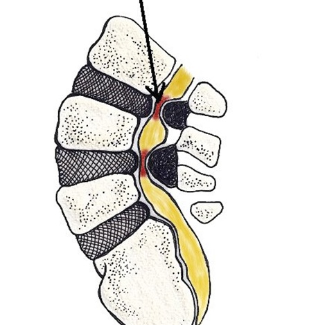 Lumbar spinal stenosis relief and active recovery Singapore