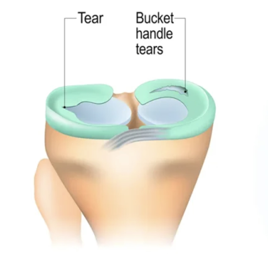 Active recovery for meniscus tear knee injury