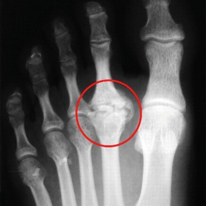 X-ray image showing metatarsal bone alignment and joint spacing for clinical diagnosis of metatarsalgia at Square One.