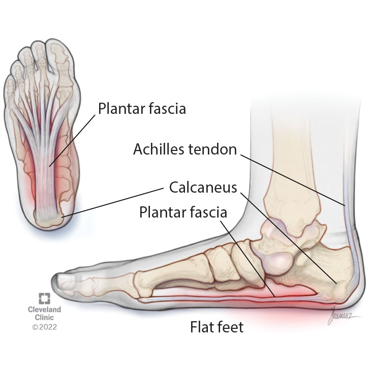 Anatomical diagram of plantar fascia inflammation and targeted heel pain treatment at Square One Singapore.