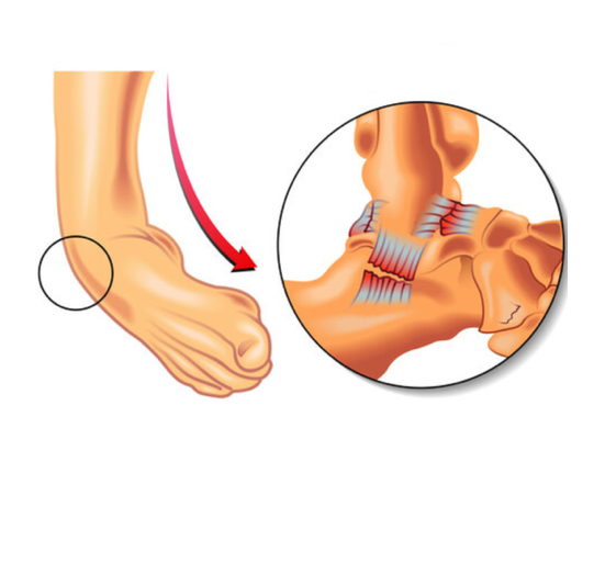 Rehabilitation for chronic ankle instability and recurring sprains using evidence-based chiropractic care.