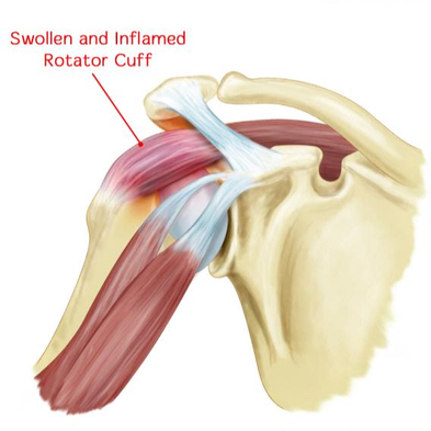 Clinical diagram illustrating rotator cuff tendinopathy anatomy and tendon loading for recovery at Square One Singapore.