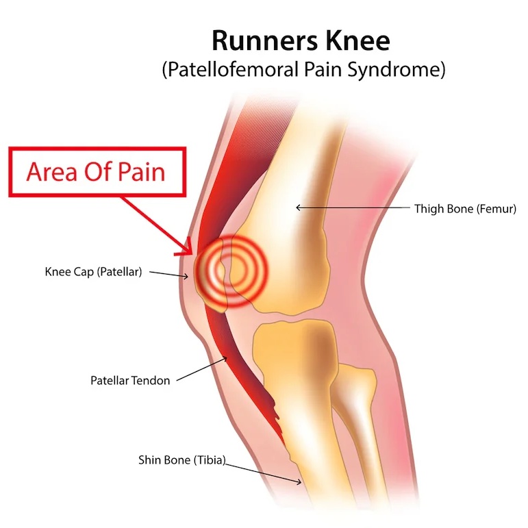 Runner's knee and patellofemoral pain syndrome treatment