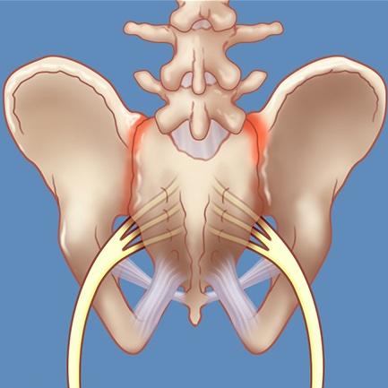 Medical illustration of sacroiliac joint (SIJ) dysfunction and inflammation
