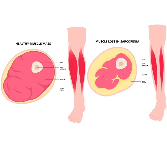 A cross-section diagram of a leg showing the difference between healthy muscle mass and sarcopenia, characterized by muscle atrophy and increased fatty tissue.
