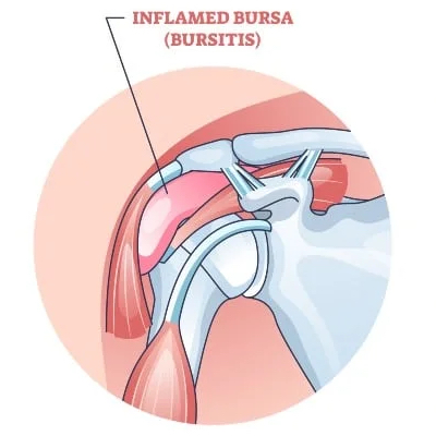 Diagram highlighting the subacromial bursa inflammation and impingement in shoulder bursitis.