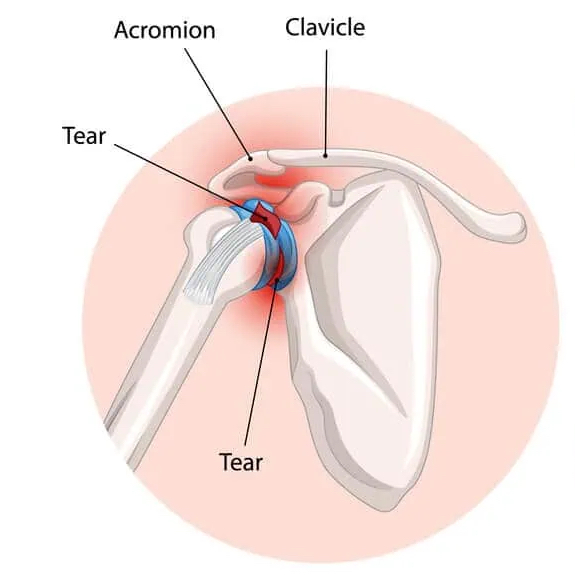 Clinical diagram of a shoulder labrum tear and the resulting joint instability.