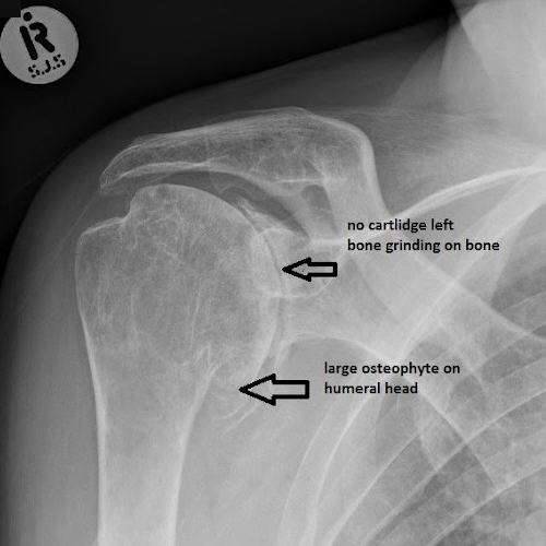 X-ray image showing shoulder osteoarthritis with joint space narrowing and bone spurs for clinical diagnosis.