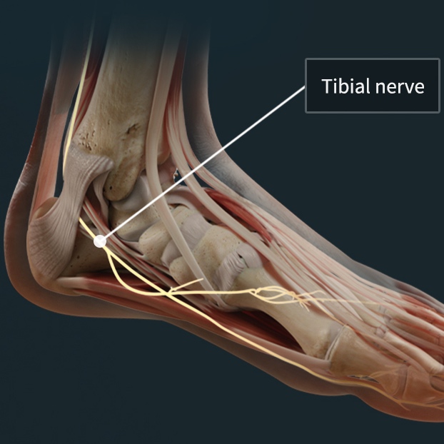 Medical illustration of tarsal tunnel syndrome and nerve entrapment management in the ankle.