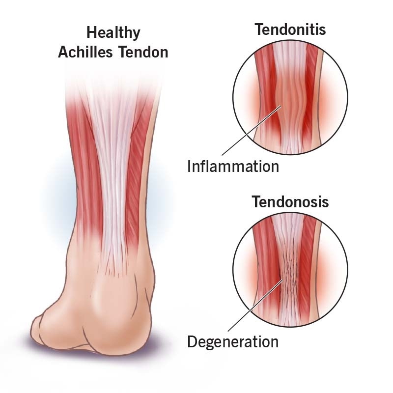 An educational diagram showing the difference between acute tendon inflammation (tendinitis) and chronic collagen degeneration (tendinosis).
