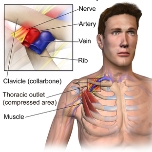 Diagram of the thoracic outlet showing compression of the brachial plexus and subclavian vessels