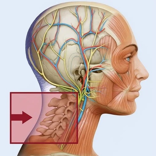 Diagram illustrating the acceleration-deceleration mechanism of injury in the cervical spine during whiplash