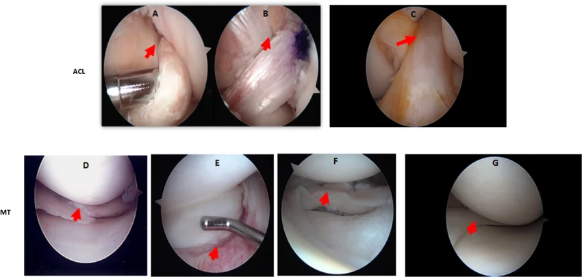 Arthroscopic images of (A) Ruptured ACL pre-surgery, (B) Reconstructed ACL post-surgery, and (C) Normal healthy ACL. Red arrows indicate pathological vs. repaired tissue.
