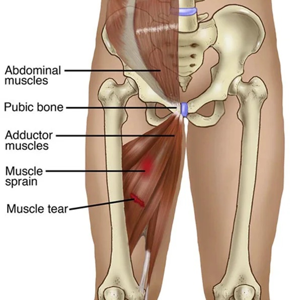 Anatomical view of adductor muscle groups and pubic symphysis highlighting common groin strain points