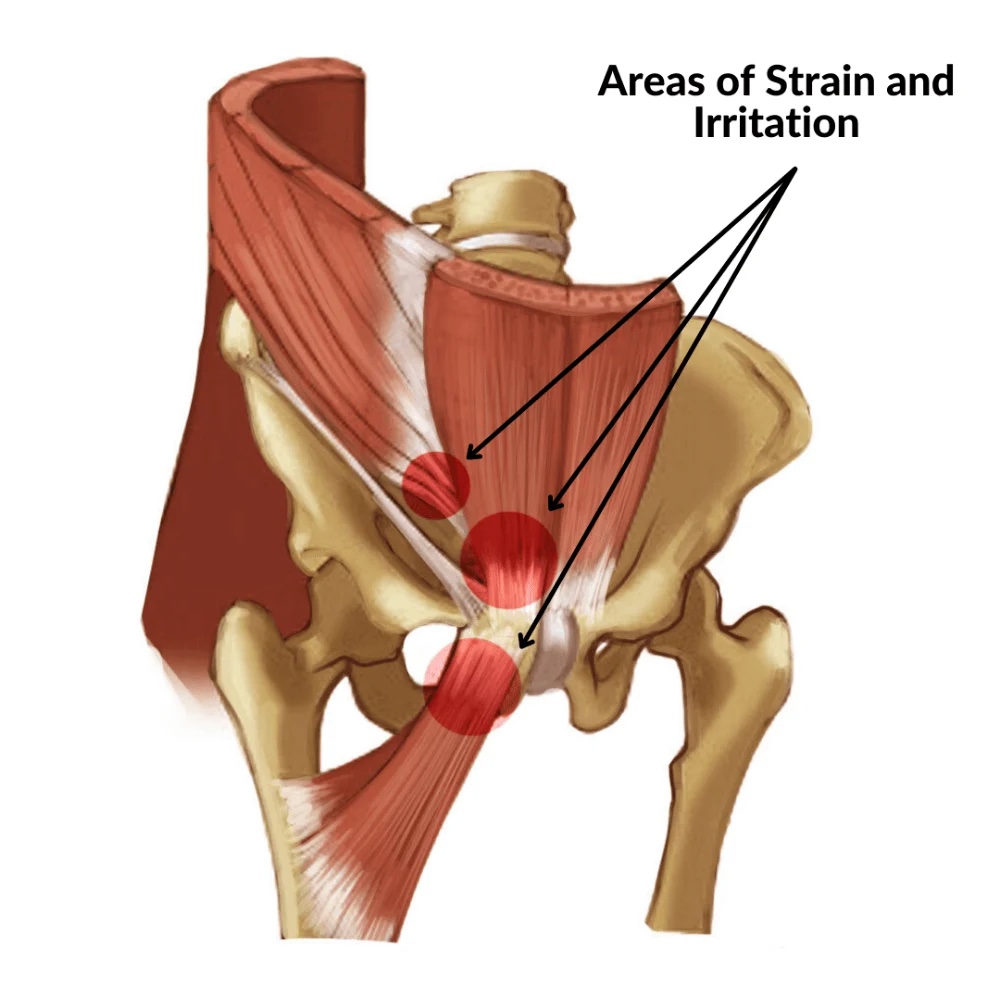 Anatomical diagram of core muscle injuries and pelvic floor involvement in athletic pubalgia