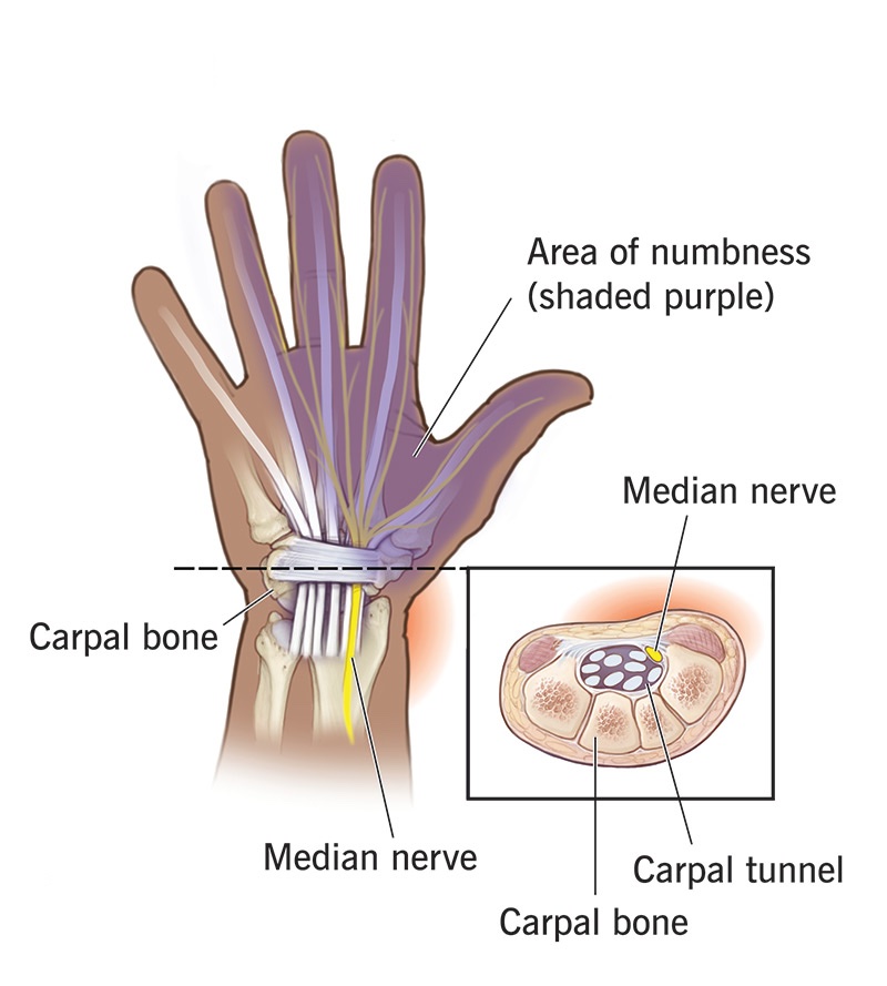 Anatomical diagram of median nerve decompression and targeted wrist flexor loading for carpal tunnel syndrome recovery