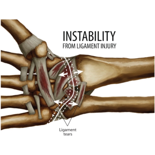 Diagram showing wrist ligament structures and proprioceptive stabilization drills to manage chronic joint laxity and clicking