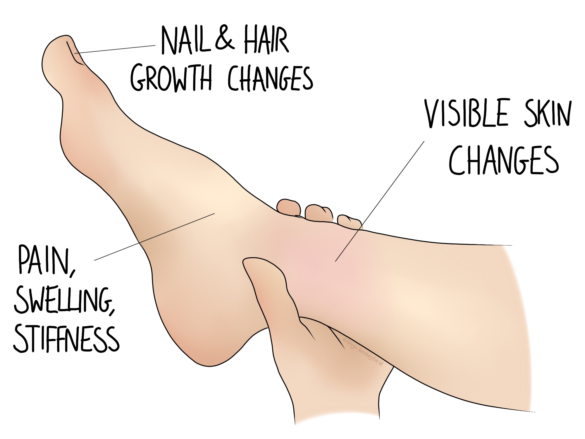 Neurological desensitization techniques for CRPS to stabilize autonomic flux and improve limb temperature regulation.