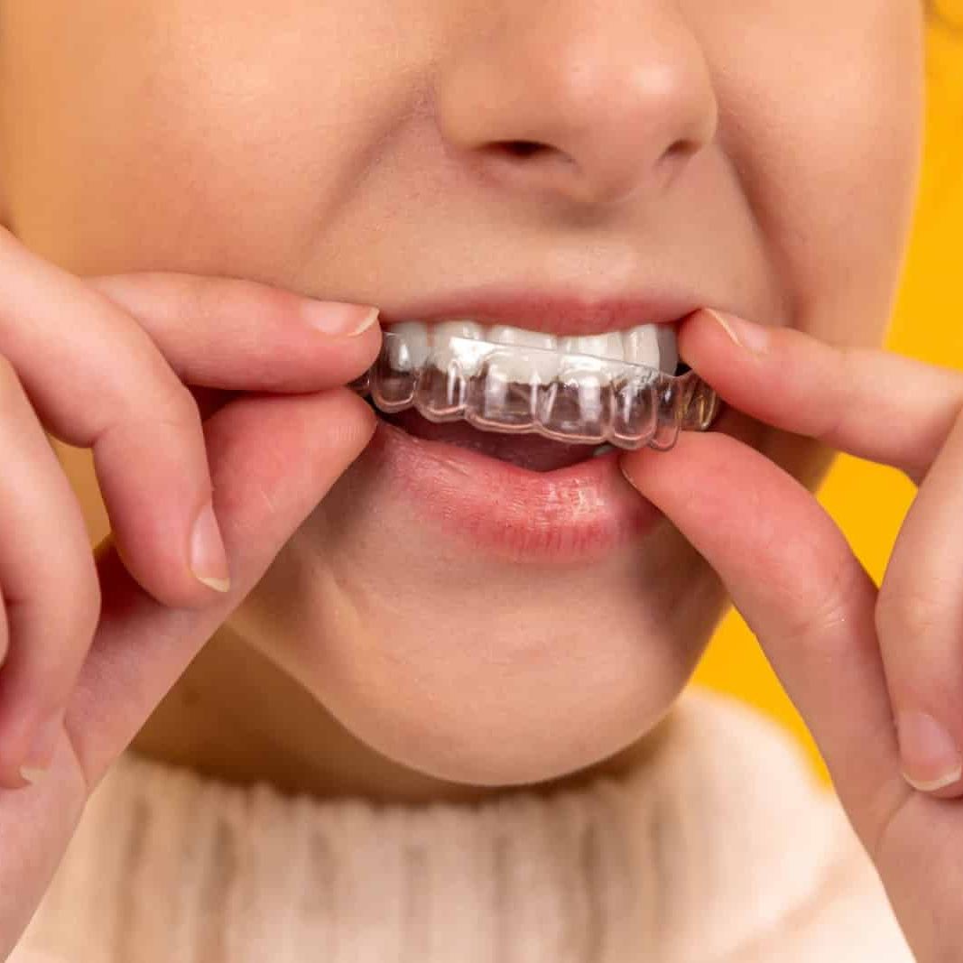 A dental night guard on a model, highlighting why oral splints only prevent tooth wear and fail to address the root cause of jaw clenching and neck instability.
