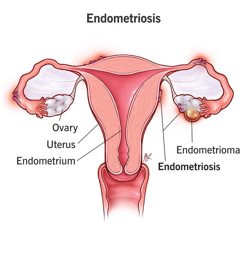 Anatomical diagram of the female reproductive system highlighting common locations of endometrial tissue growth and associated pelvic pain triggers.