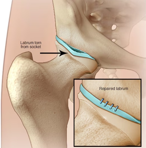 A clinical diagram showing a close up of a torn hip labrum alongside a surgically repaired labrum