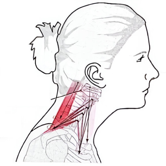 Anatomical illustration showing a female profile with forward head posture and highlighted cervical spine muscles, demonstrating how postural misalignment directly contributes to temporomandibular joint tension and facial pain.