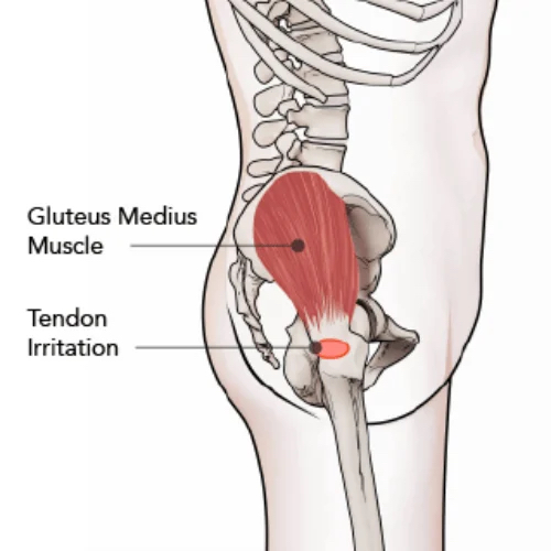 Clinical diagram of gluteal tendons showing common areas of stress and lateral hip loading