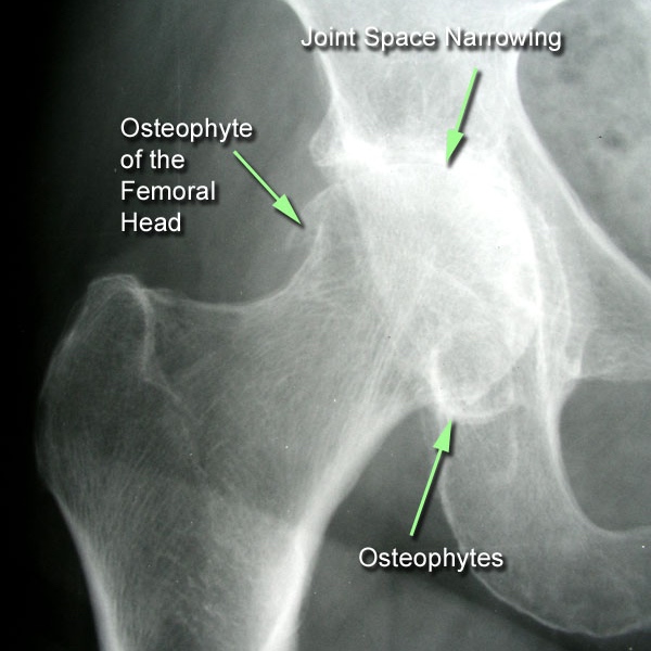 Hip X-ray showing joint space narrowing and osteophyte formation typical of osteoarthritis