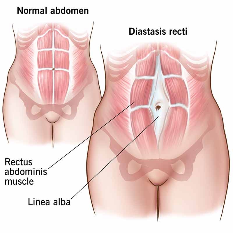Comparison diagram showing a normal abdominal wall versus various types of Diastasis Recti, highlighting the thinning and widening of the linea alba.