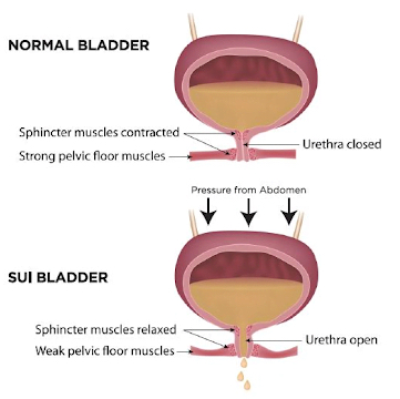 Medical diagram of the female pelvic floor muscles showing the relationship between the bladder, urethra, and muscular support involved in urinary incontinence.