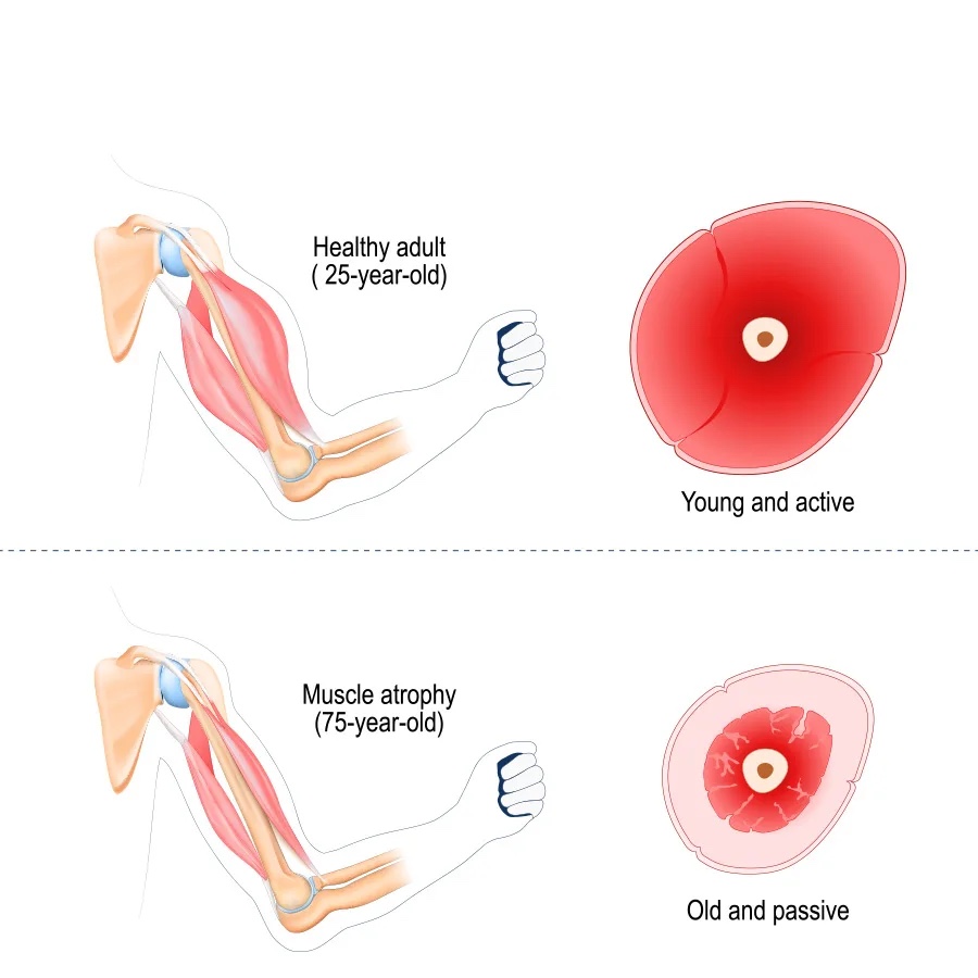 Cross-section comparison of a bicep muscle showing a healthy, dense muscle versus one with sarcopenia, illustrating significant muscle mass loss and fatty infiltration.