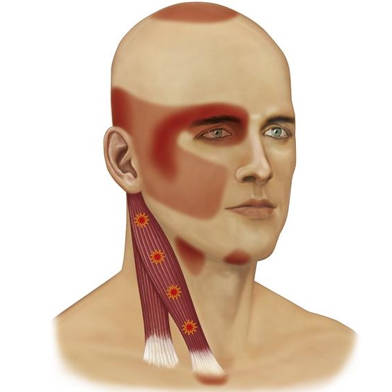 Anatomical diagram mapping neck muscle pain referral pathways to the temporomandibular joint illustrating how cervical spine muscles like the sternocleidomastoid trigger referred jaw and facial pain